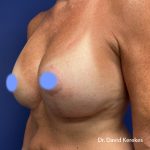 Breast Reconstruction Before & After Patient #5185