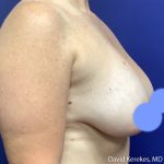 Breast Lift with Implants Before & After Patient #5139