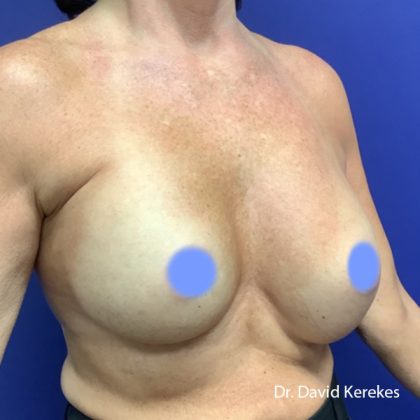 Breast Reconstruction Before & After Patient #5185
