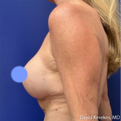 Breast Reconstruction Before & After Patient #5128
