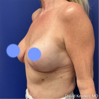 Breast Reconstruction Before & After Patient #5128