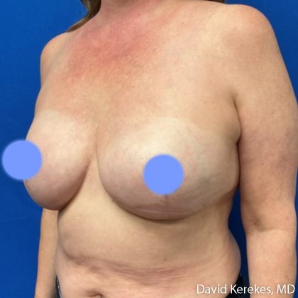 Breast Reconstruction Before & After Patient #5129
