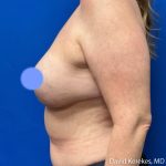 Breast Reconstruction Before & After Patient #5129