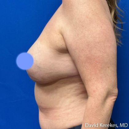 Breast Reconstruction Before & After Patient #5129