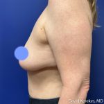 Breast Reconstruction Before & After Patient #5129