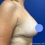 Breast Lift with Implants Before & After Patient #5139
