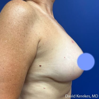 Breast Lift with Implants Before & After Patient #5139