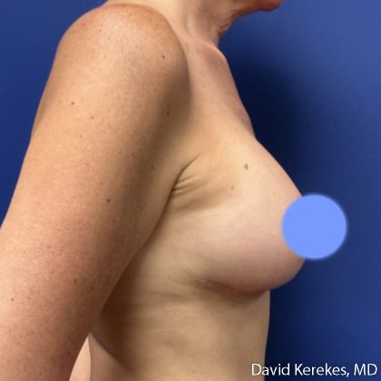 Breast Lift with Implants Before & After Patient #5138