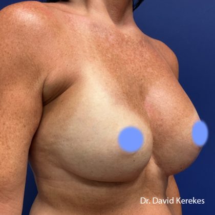 Breast Reconstruction Before & After Patient #5185