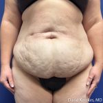Tummy Tuck Before & After Patient #5107