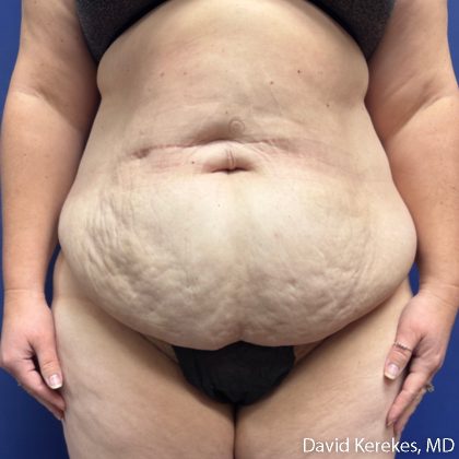 Tummy Tuck Before & After Patient #5107