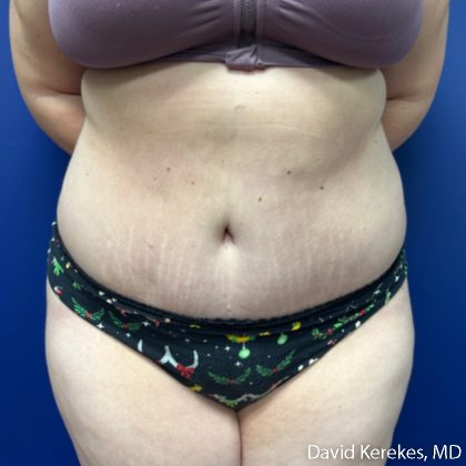 Tummy Tuck Before & After Patient #5107