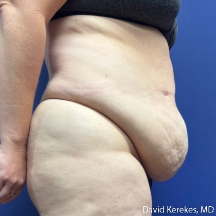 Tummy Tuck Before & After Patient #5107