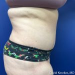 Tummy Tuck Before & After Patient #5107