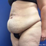 Tummy Tuck Before & After Patient #5107