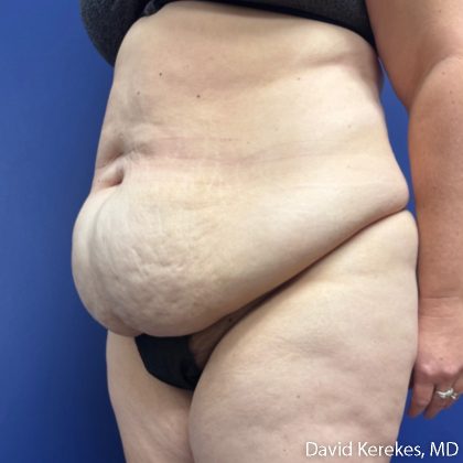 Tummy Tuck Before & After Patient #5107