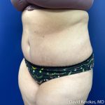 Tummy Tuck Before & After Patient #5107
