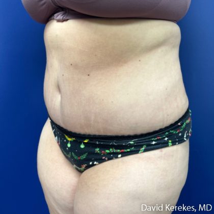 Tummy Tuck Before & After Patient #5107