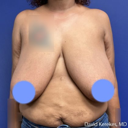 Breast Reduction Before & After Patient #5097