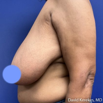Breast Reduction Before & After Patient #5097