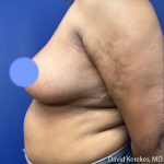 Breast Reduction Before & After Patient #5097