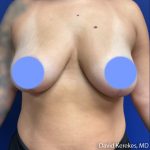 Breast Reduction Before & After Patient #5098