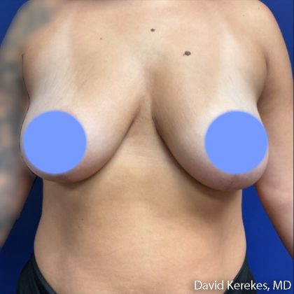 Breast Reduction Before & After Patient #5098