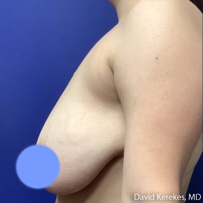Breast Reduction Before & After Patient #5098