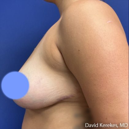 Breast Reduction Before & After Patient #5098