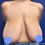 Breast Reduction Before & After Patient #5203