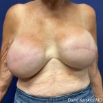 Breast Reconstruction Before & After Patient #5215