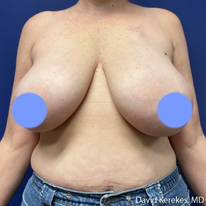 Breast Reconstruction Before & After Patient #5204