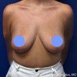 Breast Reduction Before & After Patient #5203