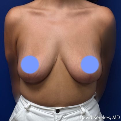 Breast Reduction Before & After Patient #5203
