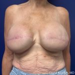 Breast Reconstruction Before & After Patient #5215