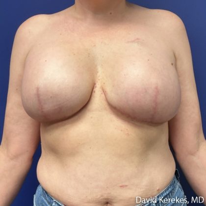 Breast Reconstruction Before & After Patient #5204