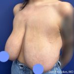 Breast Reduction Before & After Patient #5203
