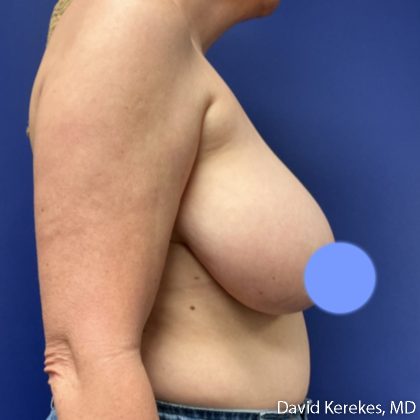Breast Reconstruction Before & After Patient #5204