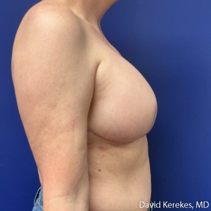 Breast Reconstruction Before & After Patient #5204