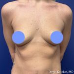 Breast Augmentation Before & After Patient #5242