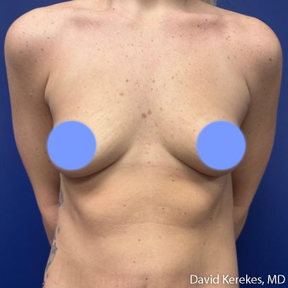 Breast Augmentation Before & After Patient #5242