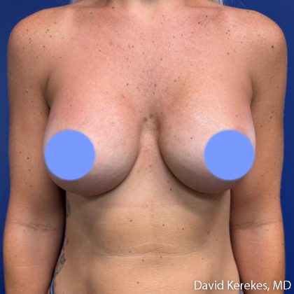 Breast Augmentation Before & After Patient #5242
