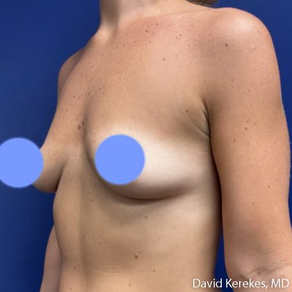 Breast Augmentation Before & After Patient #5242