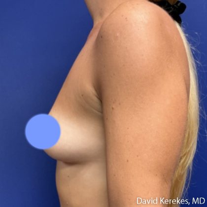 Breast Augmentation Before & After Patient #5242