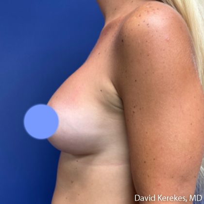 Breast Augmentation Before & After Patient #5242