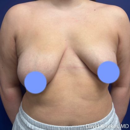 Breast Asymmetry Before & After Patient #5222