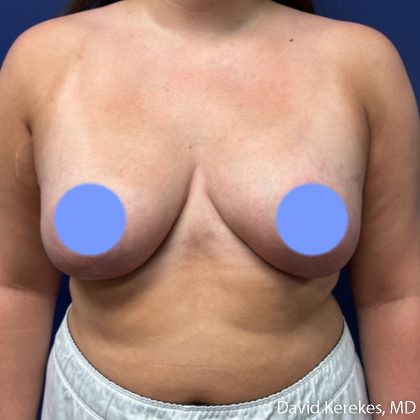 Breast Asymmetry Before & After Patient #5222