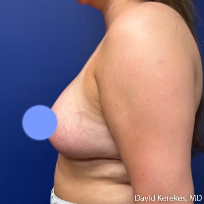Breast Asymmetry Before & After Patient #5222