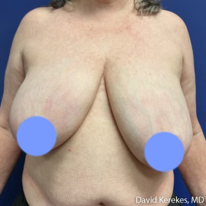 Breast Asymmetry Before & After Patient #5229