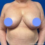 Breast Asymmetry Before & After Patient #5229